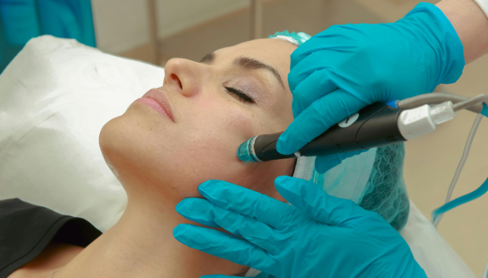 Acne Treatment in Raipur