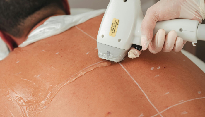 Laser Hair Removal in Raipur
