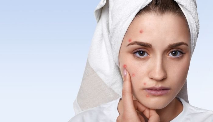 Best Acne treatment in Raipur