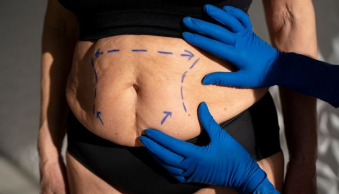 Liposuction Surgery in Raipur
